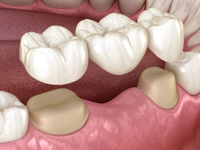 Crown Or Bridge? A Cosmetic Dentist Answers