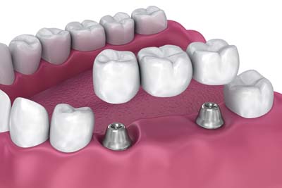 Missing A Tooth? A Dental Bridge May Be The Answer