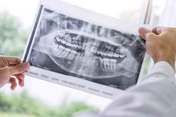 Dental Implant Restorations Milwaukee, WI