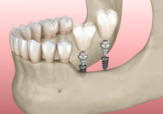 Everything You Need To Know About A Dental Implant Restoration